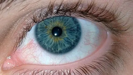 بهترین درمان خشکی چشم | مگس پران جلوی چشم چه زمانی خطرناک می شد؟