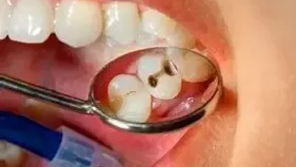 این کار مانع پوسیدگی دندان می شود