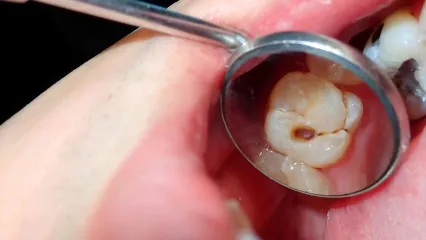 مهمترین عامل جلوگیری کننده از پوسیدگی دندان چه چیزی است؟