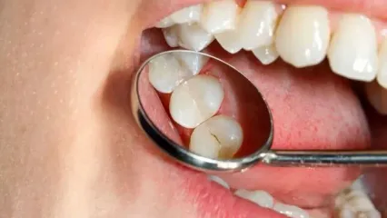 این استان بیشترین دندان خراب را دارد