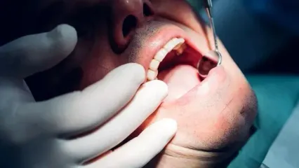 آیا دندان عقل را باید کشید؟