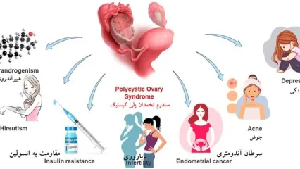 تاثیر متفورمین در درمان تنبلی تخمدان