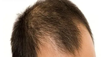 روش های تقویت مو در آقایان و خانم ها