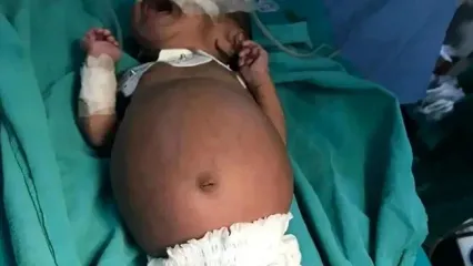 تولد نوزادی که در شکمش جنین دوقلوی خود را داشت!