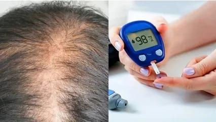 ارتباط دیابت با ریزش مو