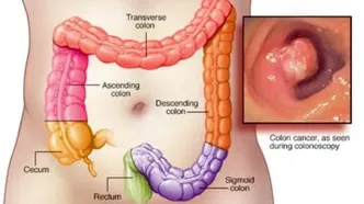 افزایش سرطان روده بزرگ در میان جوانان