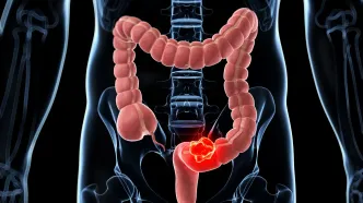 سرطان روده بزرگ در میان جوانان افزایش یافته است