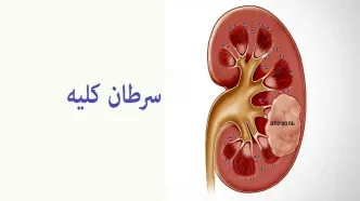 سرطان کلیه: از علائم هشداردهنده تا روش‌های نوین درمان