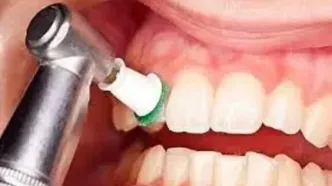 آیا جرم‌گیری به مینای دندان آسیب می‌زند؟
