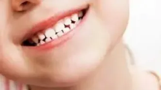 قطره آهن دندان را سیاه می کند؟