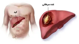 علائم و درمان سرطان کبد