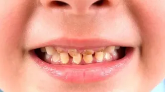 قطره آهن دندان کودک را سیاه می‌کند؟