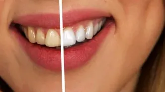 لبخندی درخشان با دندان‌هایی سفید: ۷ دلیل زرد شدن دندان و راه‌حل‌های آن