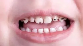 کودک‌تان دندان درآورده؟ مراقب قطره آهن باشید!