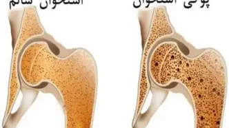 پوکی استخوان با تشخیص زود هنگام قابل درمان است