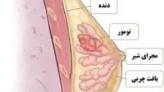 ورزش چه تاثیری بر روند سرطان سینه دارد؟