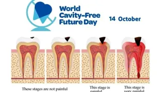 ۱۴ اکتبر روز جهانی بدون پوسیدگی دندان است