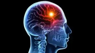 سکتهٔ مغزی ۱۴۰ هزار ایرانی در سال