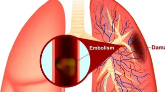 آیا این علائم را دارید؟ آمبولی ریه را جدی بگیرید! (اینفوگرافیک)