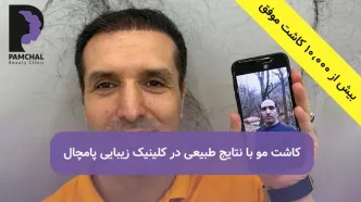 تهران، رکورد کاشت مو رو زد!