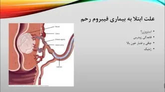 فیبروم رحم چیست ؟