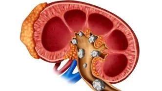 سنگ کلیه را با این روش‌ دفع کنید