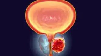 هشدار |سرطان پروستات در مردان بسیار جدی است