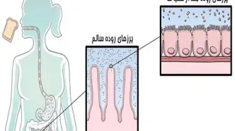 بیماری سلیاک/چگونه متوجه بیماری سلیاک در افراد شویم؟