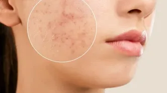 آکنه در بزرگسالی خطر ابتلا به اختلالات خوردن را افزایش می‌دهد
