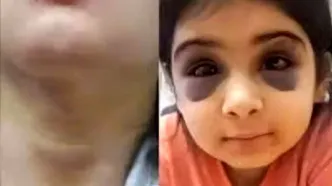 کتک کاری و آزار و اذیت کودک 9 ساله توسط نامادری