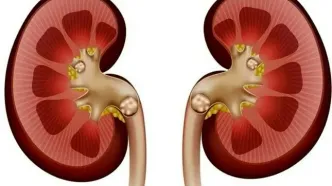 هشدار جدی:  ایران بر لبه پرتگاه «سنگ کلیه»