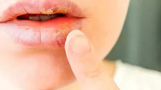 مبارزه با ویروس آنفلوآنزا و تبخال با آدامس لوبیا!