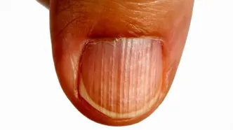 خطوط عمودی و افقی روی ناخن/ ناخن‌ها چه رازهایی درباره‌ی سلامتی شما فاش می‌کنند؟