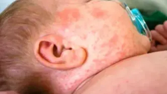 بیماری سرخک از کدام کشور وارد ایران شد؟ / سرخک به‌شدت واگیردار است