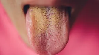 علت زرد بودن زبان/ چطور می‌توان زردی زبان را درمان کرد؟