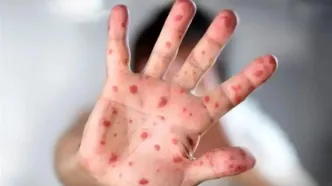 بیماری سرخک از کدام کشور وارد ایران شد؟