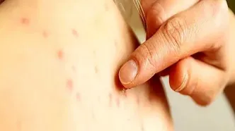 ابتلای ۱۰۰۰ نفر در ایران به یک بیماری مسری