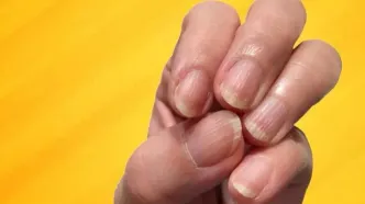 خطوط عمودی یا افقی روی ناخن‌ها علامت چیست؟