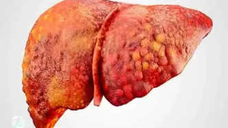ورزش‌های مناسب برای مقابله با کبد چرب
