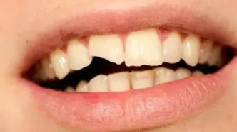 چرا دندان‌ها زود به زود پوسیده می‌شوند؟
