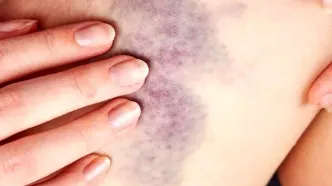 کبود شدن بی‌دلیل پوست بدن علت طبیعی دارد؟