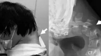 بیماری سندرم سر افتاده چه علائمی دارد؟/ عکس