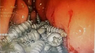از معده یک بیمار کرجی  ۴۷ پیچ فلزی بدون جراحی خارج شد