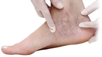این علائم در پا را جدی بگیرید
