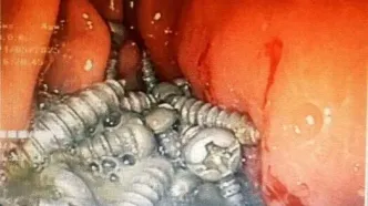 خروج ۴۷ پیچ از معده یک بیمار در کرج بدون جراحی!