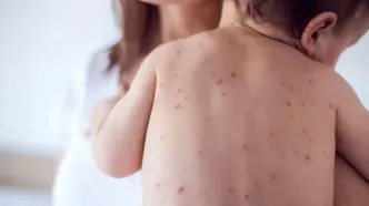 زنگ خطر شیوع مجدد سرخک به صدا درآمد