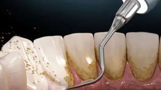 تاثیرات جرم گرفتن دندان‌ها بر سلامت؛ جرم‌گیری بکنیم یا نه؟