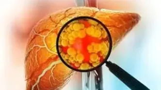 رابطه  PCOS با ابتلا به  کبد چرب!