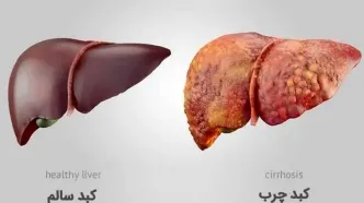 پایان کبد چرب/ قدرت شگفت‌انگیز انتخاب‌های روزمره شما!