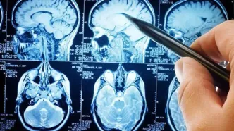 پیشگیری آسان از سکته مغزی با چند نکته کلیدی